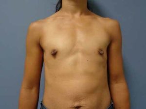 Breast Augmentation Before & After Pictures in Nashville, TN