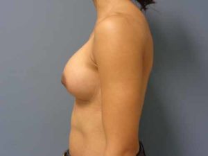 Breast Augmentation Before & After Pictures in Nashville, TN