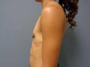 Breast Augmentation Before & After Pictures in Nashville, TN