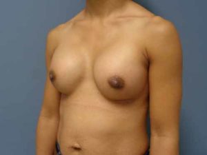 Breast Augmentation Before & After Pictures in Nashville, TN