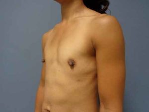 Breast Augmentation Before & After Pictures in Nashville, TN