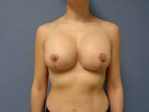 Breast Augmentation with Lift Before and After Pictures Nashville, TN