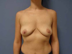 Breast Augmentation with Lift Before and After Pictures Nashville, TN