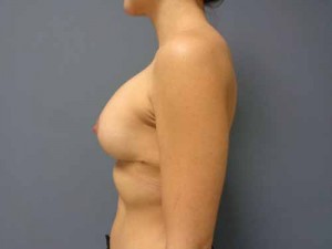 Breast Augmentation with Lift Before and After Pictures Nashville, TN