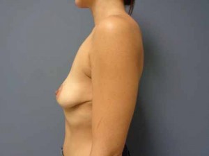 Breast Augmentation with Lift Before and After Pictures Nashville, TN