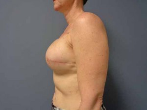 Breast Reconstruction Before and After Pictures Nashville, TN