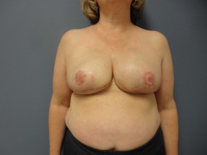 Breast Reconstruction Before and After Pictures Nashville, TN