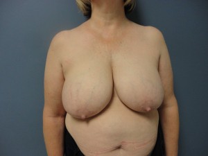 Breast Reconstruction Before and After Pictures Nashville, TN