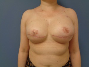 Breast Reconstruction Before and After Pictures Nashville, TN