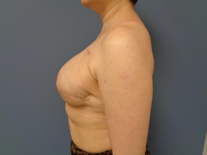 Breast Reconstruction Before and After Pictures Nashville, TN