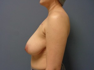 Breast Reconstruction Before and After Pictures Nashville, TN