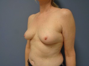 Breast Reconstruction Before and After Pictures Nashville, TN