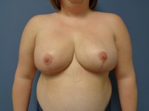 Breast Reduction Before and After Pictures Nashville, TN