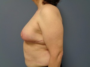 Breast Reduction Before and After Pictures Nashville, TN