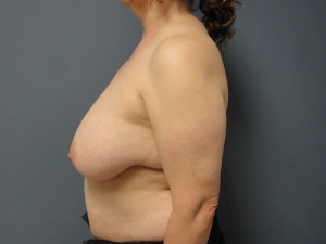 Breast Reduction Before and After Pictures Nashville, TN