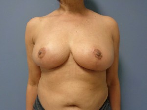 Breast Reduction Before and After Pictures Nashville, TN