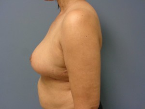 Breast Reduction Before and After Pictures Nashville, TN