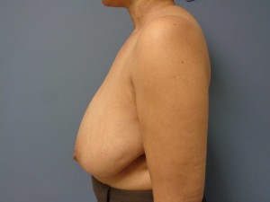 Breast Reduction Before and After Pictures Nashville, TN