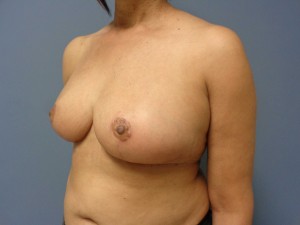 Breast Reduction Before and After Pictures Nashville, TN