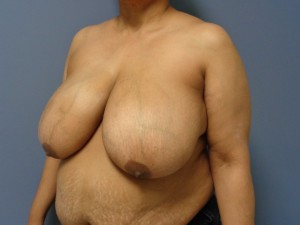 Breast Reduction Before and After Pictures Nashville, TN