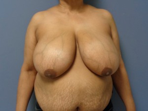 Breast Reduction Before and After Pictures Nashville, TN