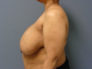 Breast Reduction Before and After Pictures Nashville, TN