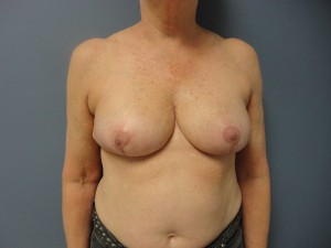 Breast Reduction Before and After Pictures Nashville, TN