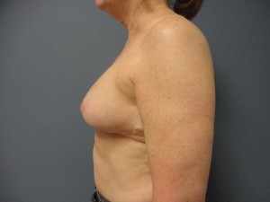 Breast Reduction Before and After Pictures Nashville, TN