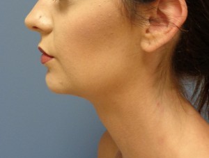 Chin Augmentation Before and After Pictures Nashville, TN