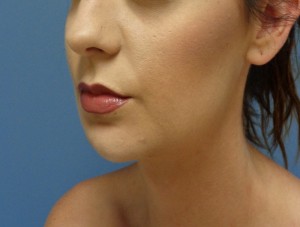 Chin Augmentation Before and After Pictures Nashville, TN