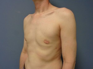 Gynecomastia Before and After Pictures Nashville, TN