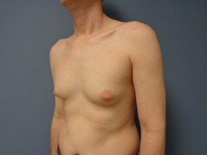 Gynecomastia Before and After Pictures Nashville, TN