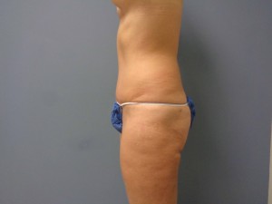 Tummy Tuck Before and After Pictures Nashville, TN