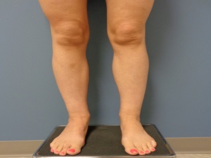 Liposuction Before and After Pictures Nashville, TN