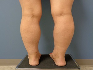 Liposuction Before and After Pictures Nashville, TN