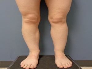 Liposuction Before and After Pictures Nashville, TN