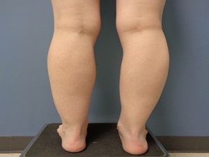 Liposuction Before and After Pictures Nashville, TN