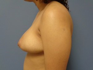 Breast Reduction Before and After Pictures Nashville, TN