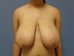 Breast Reduction Before and After Pictures Nashville, TN