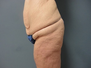 Butt Augmentation Before and After Pictures Nashville, TN