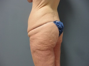 Butt Augmentation Before and After Pictures Nashville, TN