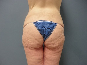 Butt Augmentation Before and After Pictures Nashville, TN