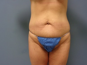 Tummy Tuck Before and After Pictures Nashville, TN