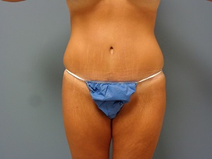 Tummy Tuck Before and After Pictures Nashville, TN