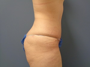 Tummy Tuck Before and After Pictures Nashville, TN