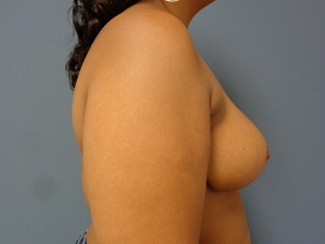 Breast Reduction Before and After Pictures Nashville, TN