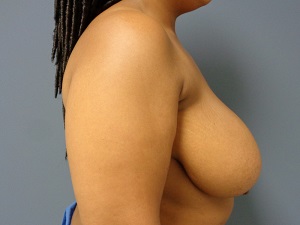 Breast Reduction Before and After Pictures Nashville, TN