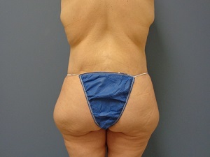 Body Lift Before and After Pictures Nashville, TN
