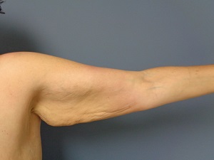 Arm Lift Before and After Pictures Nashville, TN