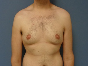 Gynecomastia Before and After Pictures Nashville, TN